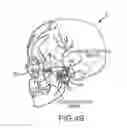 Fig. 07 - Extracranial implantable devices, systems and methods for the treatment of neuropsychiatric disorders