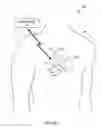 Fig. 04 - Mode switching by a ventricular leadless pacing device
