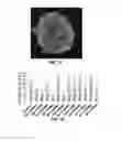 Fig. 24 - FORMATION OF MULTICELLULAR TUMOROIDS AND USES THEREOF