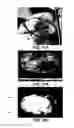 Fig. 11 - Fluorescence biopsy specimen imager and methods