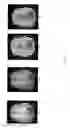 Fig. 34 - MRI with reconstruction of MR phase image
