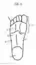 Fig. 02 - Modified shoe permitting forefoot extension for natural supination and pronation