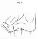 Fig. 04 - Modified shoe permitting forefoot extension for natural supination and pronation