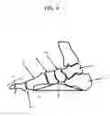 Fig. 05 - Modified shoe permitting forefoot extension for natural supination and pronation