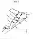 Fig. 07 - Modified shoe permitting forefoot extension for natural supination and pronation