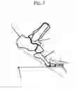 Fig. 08 - Modified shoe permitting forefoot extension for natural supination and pronation