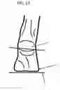 Fig. 14 - Modified shoe permitting forefoot extension for natural supination and pronation