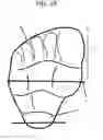 Fig. 15 - Modified shoe permitting forefoot extension for natural supination and pronation