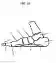 Fig. 17 - Modified shoe permitting forefoot extension for natural supination and pronation