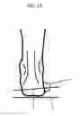 Fig. 20 - Modified shoe permitting forefoot extension for natural supination and pronation