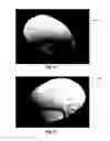 Fig. 06 - Methods, systems and instruments for creating partial model of a head for use in hair transplantation