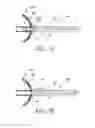 Fig. 08 - METHOD OF REMOVING AN INFLATED IMPLANT FROM A BLADDER