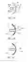 Fig. 09 - METHOD OF REMOVING AN INFLATED IMPLANT FROM A BLADDER
