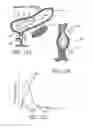 Fig. 24 - METHOD OF REMOVING AN INFLATED IMPLANT FROM A BLADDER