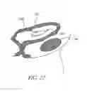 Fig. 26 - METHOD OF REMOVING AN INFLATED IMPLANT FROM A BLADDER