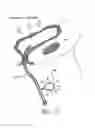 Fig. 27 - METHOD OF REMOVING AN INFLATED IMPLANT FROM A BLADDER
