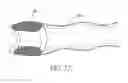 Fig. 30 - METHOD OF REMOVING AN INFLATED IMPLANT FROM A BLADDER