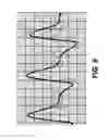 Fig. 10 - SYSTEMS AND METHODS FOR PERFORMING AN OBJECTIVE ANALYSIS OF AIR PLETHYSMOGRAPHY WAVEFORM