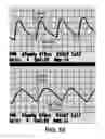 Fig. 11 - SYSTEMS AND METHODS FOR PERFORMING AN OBJECTIVE ANALYSIS OF AIR PLETHYSMOGRAPHY WAVEFORM