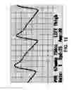 Fig. 13 - SYSTEMS AND METHODS FOR PERFORMING AN OBJECTIVE ANALYSIS OF AIR PLETHYSMOGRAPHY WAVEFORM