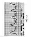 Fig. 14 - SYSTEMS AND METHODS FOR PERFORMING AN OBJECTIVE ANALYSIS OF AIR PLETHYSMOGRAPHY WAVEFORM