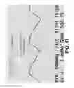 Fig. 18 - SYSTEMS AND METHODS FOR PERFORMING AN OBJECTIVE ANALYSIS OF AIR PLETHYSMOGRAPHY WAVEFORM