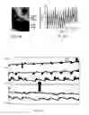 Fig. 03 - SENSOR FOR VENTRICULAR AND OUTFLOW TRACT OBSTRUCTION