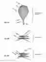 Fig. 08 - Occlusion device and method for its manufacture