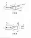 Fig. 03 - Bone anchor assembly