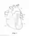 Fig. 02 - Exclusion of the left atrial appendage