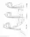 Fig. 23 - Cross-sectional modification during deployment of an elongate lung volume reduction device