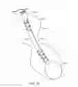 Fig. 25 - Cross-sectional modification during deployment of an elongate lung volume reduction device