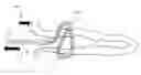 Fig. 01 - Atrial appendage occlusion systems and methods of using the same