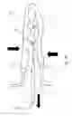 Fig. 05 - Atrial appendage occlusion systems and methods of using the same