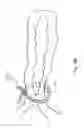 Fig. 26 - Atrial appendage occlusion systems and methods of using the same