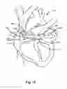 Fig. 29 - Atrial appendage occlusion systems and methods of using the same