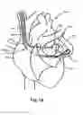 Fig. 31 - Atrial appendage occlusion systems and methods of using the same