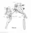 Fig. 65 - FACET JOINT REPLACEMENT INSTRUMENTS AND METHODS