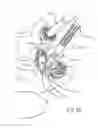 Fig. 69 - FACET JOINT REPLACEMENT INSTRUMENTS AND METHODS