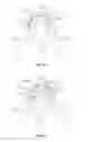 Fig. 28 - Methods and apparatus for treating vertebral fractures