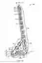 Fig. 02 - Ankle tibia plates