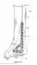 Fig. 03 - Ankle tibia plates