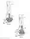 Fig. 06 - Ankle tibia plates