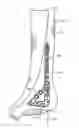 Fig. 01 - Ankle tibia plates