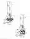 Fig. 06 - Ankle tibia plates