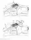 Fig. 06 - Patella bone plate and methods of fixation