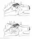 Fig. 07 - Patella bone plate and methods of fixation