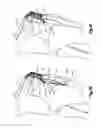 Fig. 08 - Patella bone plate and methods of fixation