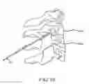 Fig. 20 - Methods and systems for spinal radio frequency neurotomy