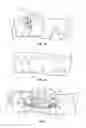 Fig. 04 - Method and apparatus for restoring improper morphology of the alveolar bone